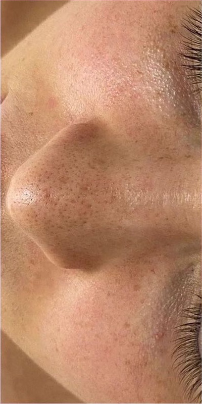 После курса Dermadrop TDA с сывороткой HYAL N10 TDA в MISA Aesthetic Clinic Ковров