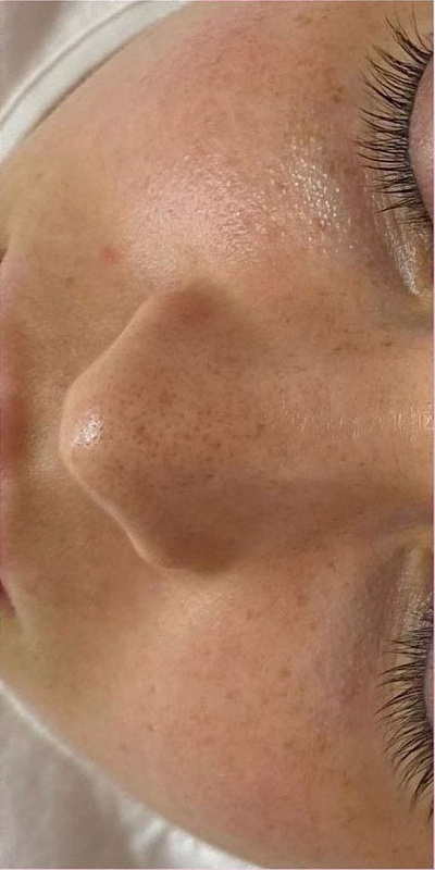 До процедуры Dermadrop TDA для увлажнения кожи, Ковров